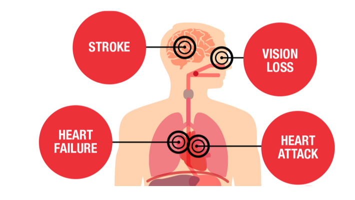 اضرار ارتفاع ضغط الدم